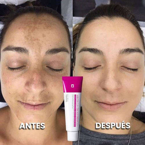Dermanix - Tratamiento Anti-Melasma