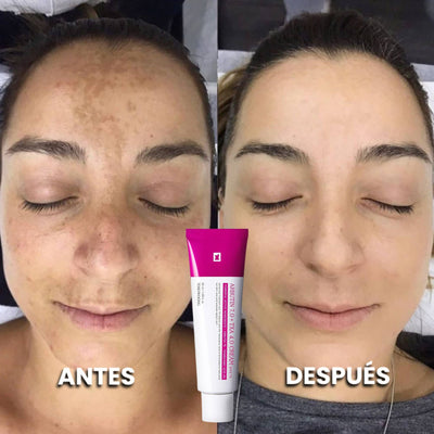 Dermanix - Tratamiento Anti-Melasma