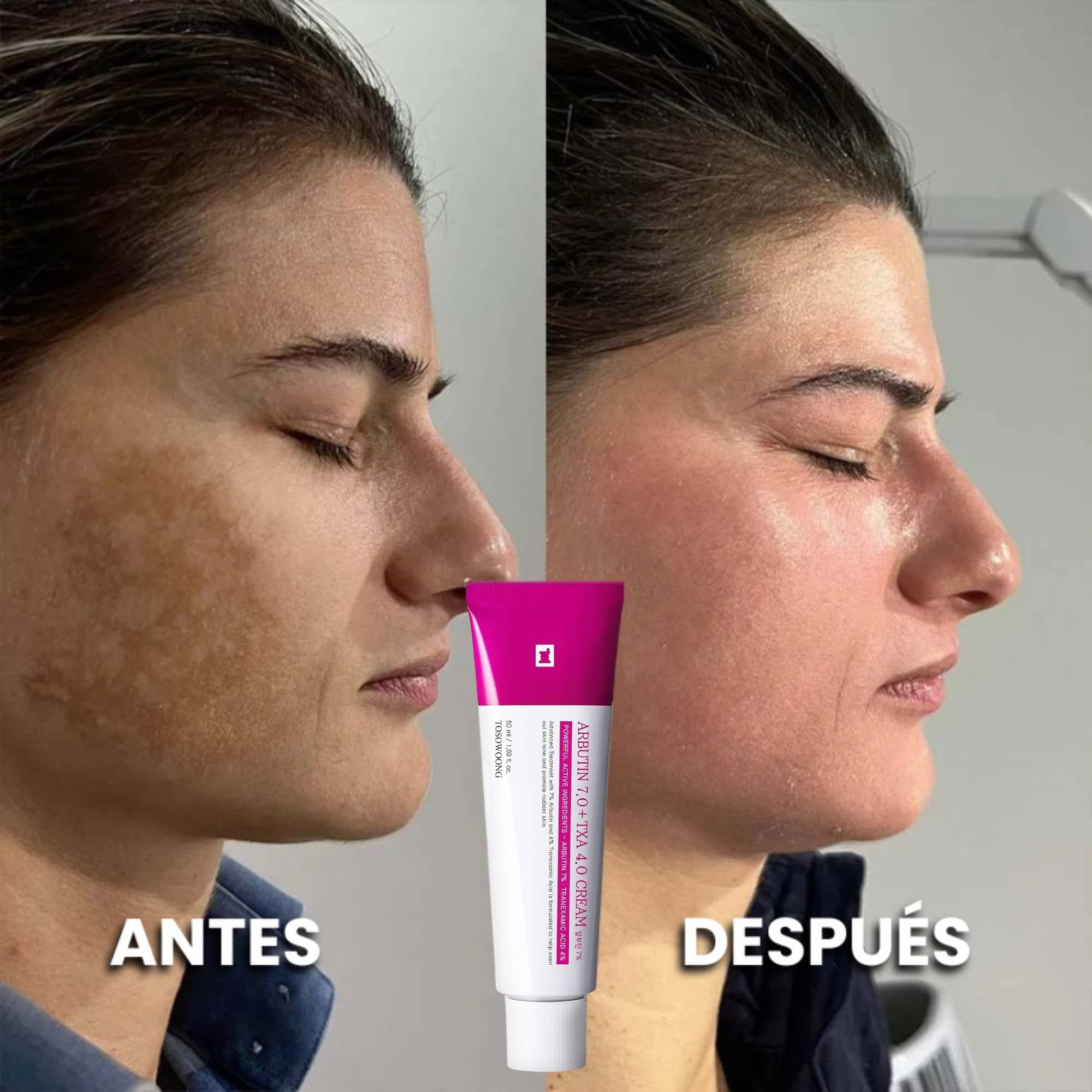 Dermanix - Tratamiento Anti-Melasma