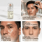 Queriva™ Sebo-Control