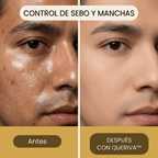 Queriva™ Sebo-Control